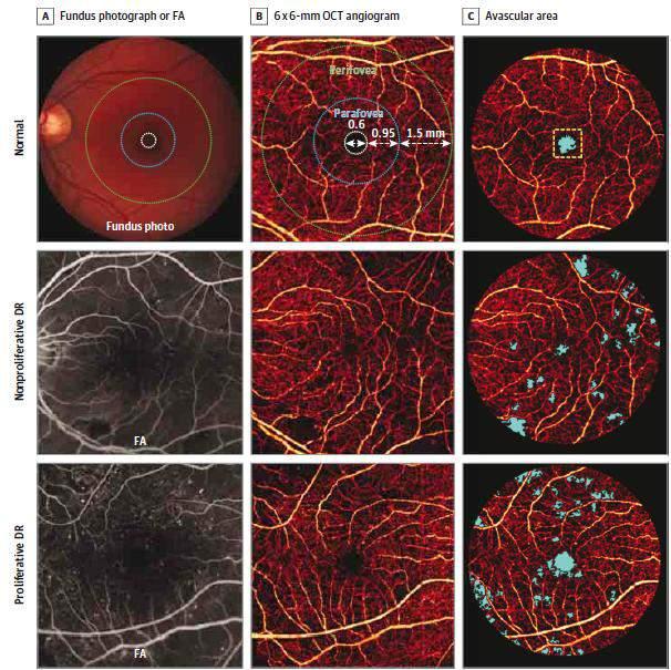12 occhi con differenti stadi di RD vs controlli Rispetto ai controlli, le densità dei vasi para e perifoveali è risultata