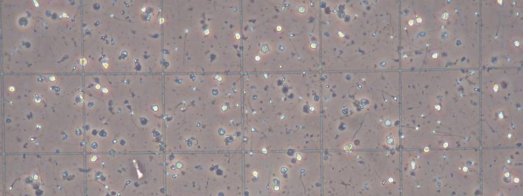 19 Astinenza 4 gg 4 dicembre 2013 Volume 4 ml Round cells 3000/mm3 (3.000.000/ml) Colore avorio Leucociti 150/mm3 (150.