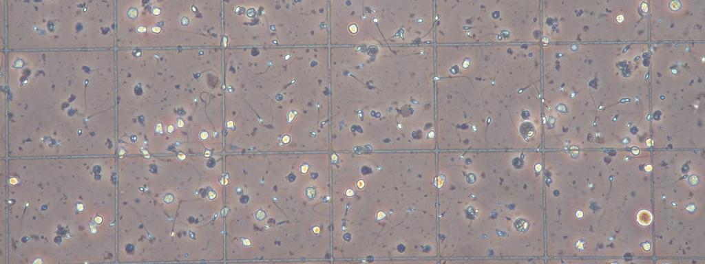 Fluidificazione completa Agglutinati assenti ph 7,3 Cellule germinali immature presenti Concentrazione 15.000/mm3 Conta totale 60.000.000 15.000.000/ml Motilità 60 tipo a (progr.