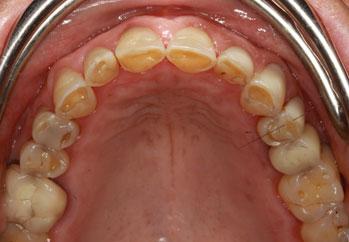 masticatorie (notare come sono scavati internamente i denti anteriori superiori.), già a 55 anni. L usura si può quantificare in 2/3 millimetri ad arcata.