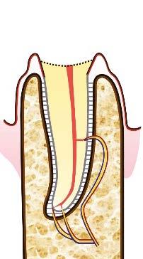 3) radicolare profonda verticale infraossea (l unica situazione fra tutte le patologie della bocca,