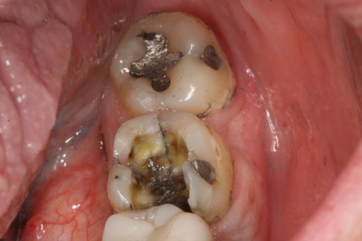 una radiografia, ma la sintomatologia può essere molto sgradevole alla masticazione.