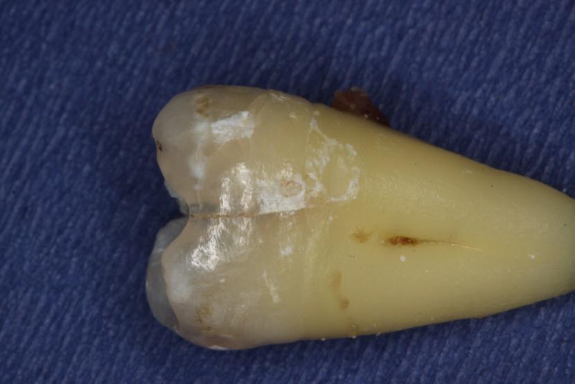 Sopra a destra. La radiografia non evidenziava logicamente la frattura (che aveva andamento da dietro in avanti)- Sopra a sinistra. Il dente è stato estratto e si evidenzia meglio l incrinatura.