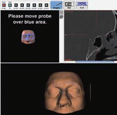 rilevamento della superficie cutanea con la sonda di registrazione Il surface matching può ora essere impiegato per la registrazione del paziente in alternativa alla procedura di registrazione