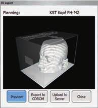 Stampa in 3D delle strutture specifiche del paziente Il nuovo modulo di esportazione 3D consente la stampa di modelli in 3D di strutture specifiche del paziente.