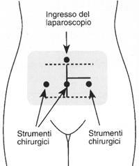 operatorio, e di conseguenza del proprio patrimonio follicolare, con possibili risvolti in termini di fertilità (osservazione valida soprattutto nel caso di cisti endometriosica) - asportazione anche