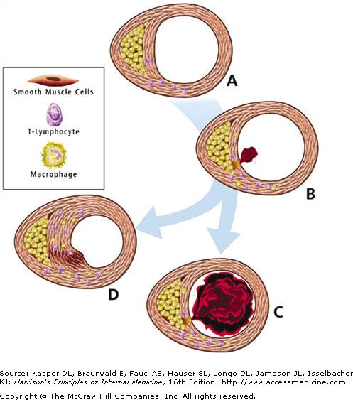 Aterogenesi e complicazioni A. Nella fase iniziale dell ateroma, la crescita avviene spesso verso l esterno, preservando il calibro del lume. B. Trombosi.