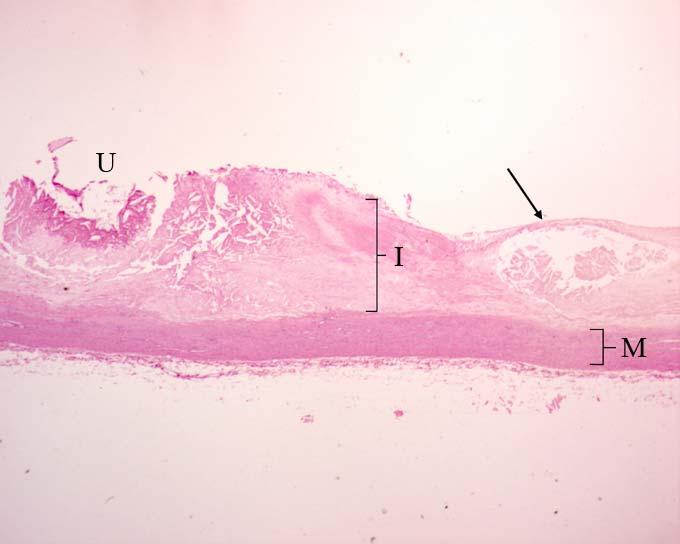 Aterosclerosi (aorta), ematossilina/eosina. La placca ateromasica consiste in un ispessimento localizzato della tonaca intima. (Tonaca Intima = I; Tonaca Media = M).