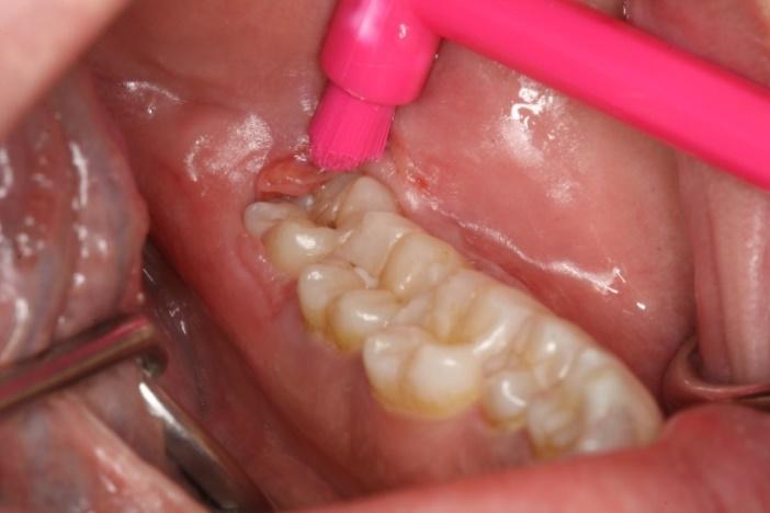 come: - la parte posteriore della bocca, sul dente 8 (del giudizio), erotto perfettamente o erotto parzialmente (cioè ricoperto da una quantità di gengiva che trattiene placca), - dietro a un dente