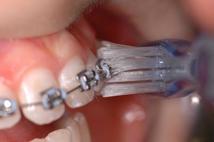 4) Lo spazzolino ortodontico e lo spazzolino sulculare, utili per i pazienti in trattamento ortodontico.