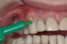 l Odontoiatra oin genere l Igienista, consiglierà e consegnerà al paziente quelli con il giusto diametro che con
