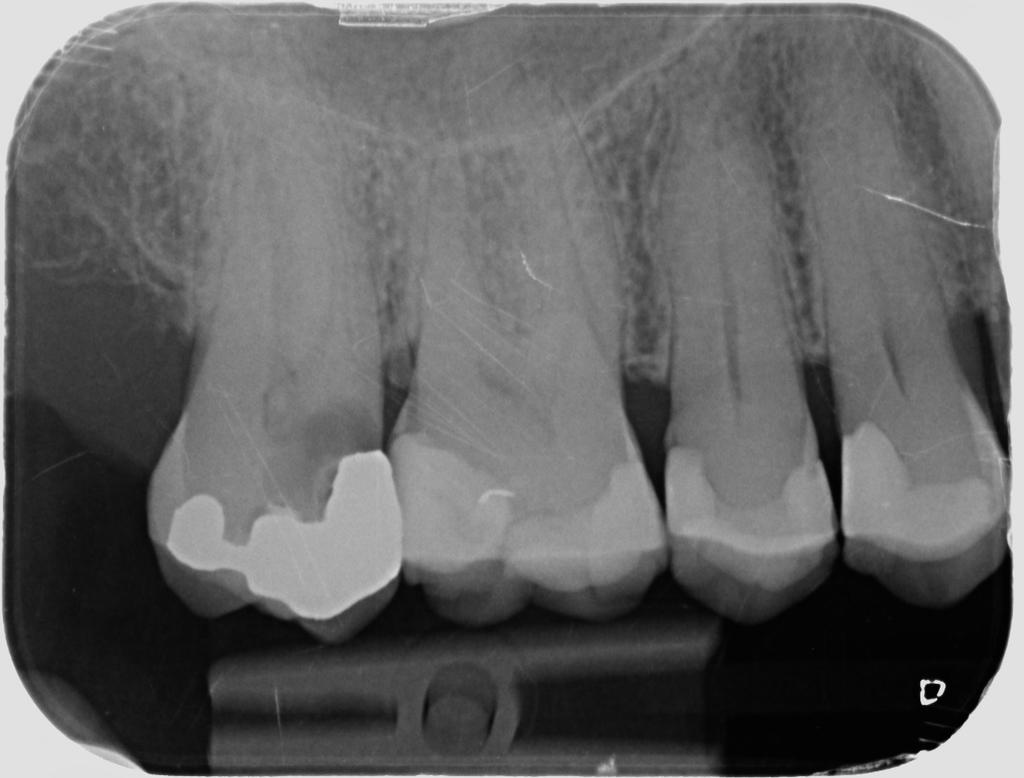 Dalla Radiografia panoramica emergeva una carie profondissima a destra ma in alto, che aveva già indotto la pulpite al nervo e questo dolore non era classicamente localizzabile.