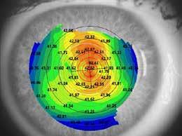 Report Topografia TOPCON Patient Information Patient TOPCON EUROPE MEDICAL Gender F Patient ID 123456789 Exam Date 14/08/2017 14:33:17 Date of Birth 01/01/1900 Surgeon TOPOGRAPHICAL MAP OD OS D