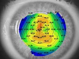 15 mm Cornea Decentralization X - Y 0.43 mm -0.14 mm Diameter 12.33 mm Diameter 12.19 mm Pupillar Decentralization X - Y H= -0.25 mm V= 0.06 mm Pupillar Decentralization X - Y H= 0.36 mm V= -0.
