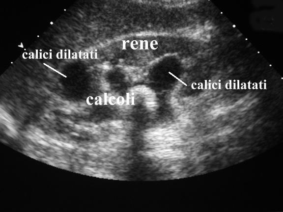 Viene ricoverata con diagnosi di sepsi