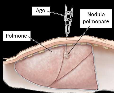 Figura 1 Agobiopsia percutanea di un nodulo polmonare sospetto Il campione prelevato mediante biopsia viene poi analizzato dal patologo che, avvalendosi di particolari tecniche di preparazione e