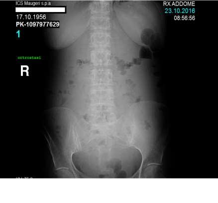 Ottobre 2016: avvia chemioterapia di III linea con Doxorubicina liposomiale Dopo il primo ciclo quadro clinico subocclusivo, per cui viene ricoverata in regime di degenza All Rx addome: