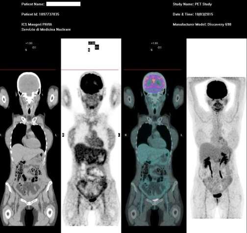 Febbraio 2015: completa 6 cicli di chemioterapia Alla PET di ristadiazione non evidenza di malattia.