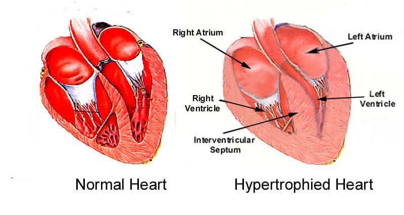 Stadio B (sviluppo di cardiopatia strutturale) Cardiopatia strutturale, senza sintomi di scompenso Tutte le misure dello stadio A Controllo