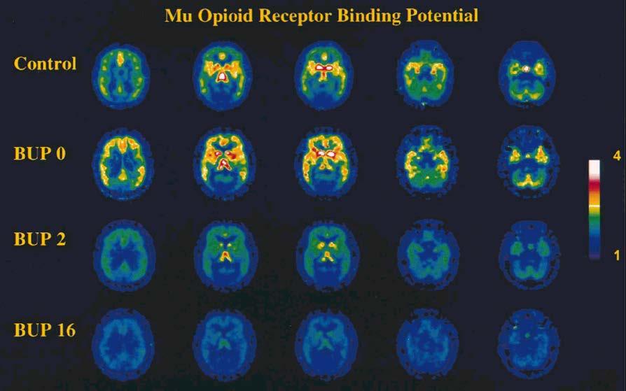 Occupazione della buprenorfina al recettore µ misurata con 11 C-Carfentanil Controllo e volontario eroinomane