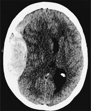 EMATOMA EPIDURALE ACUTO Outcome -Mortalità:10% (GCS 3-5:36%; GCS:6-8 :9%) -Mortalità:26% ematomi FCP -Outcome peggiore se associate altre lesioni