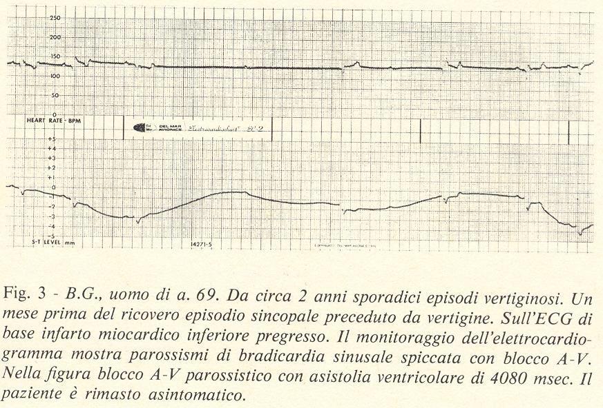 Blocco A-V