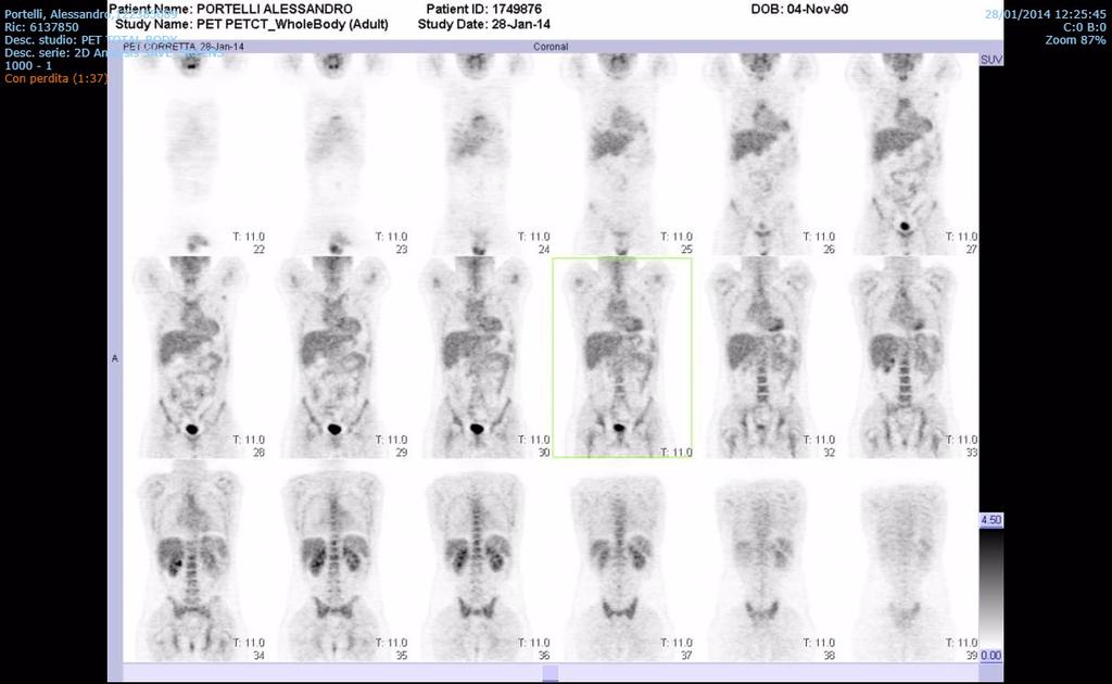 lesioni eteroproduttive ad elevato metabolismo glucidico ma il loro incremento metabolico nel tempo (seppur modesto) li