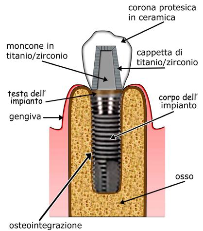 PDF0. Notizie utili sull implantologia. Cos è un impianto, e di cosa è costituito?