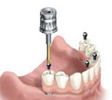 Sabato 15.09.2018 - ore 8.30-17.00 Corso teorico/pratico LA STRUMENTAZIONE ENDODONTICA Dott.