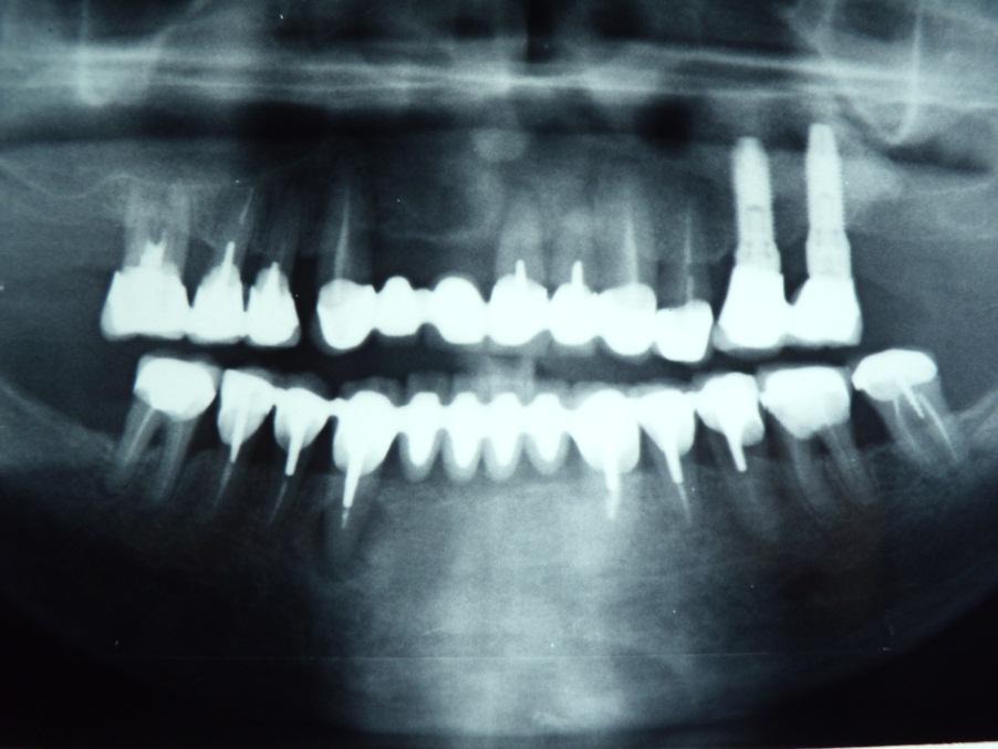 Implanti dentari