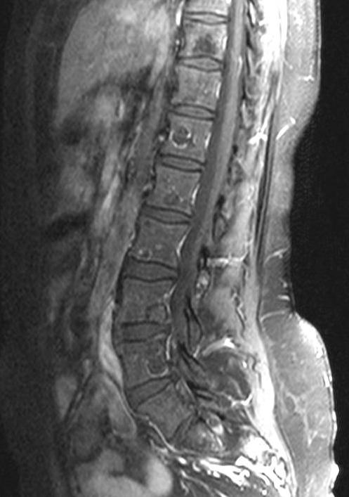 ) Terapia di seconda linea con capecitabina e lapatinib (inibitore HER2 ed HER1) sospesa dopo il primo ciclo per