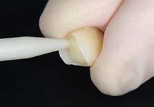 Precondizionamento del dente Applicazione del
