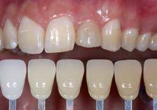 Determinazione del colore del dente