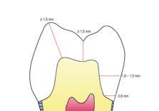 1,0 mm 1 mm 1,5 mm 0,5 mm 0,5-0,7 mm 0,2-0,3 mm Faccette Labiale: Terzo incisale: Terzo centrale: Terzo cervicale: mediamente 0,5 mm 0,5-0,7 mm 0,5 mm