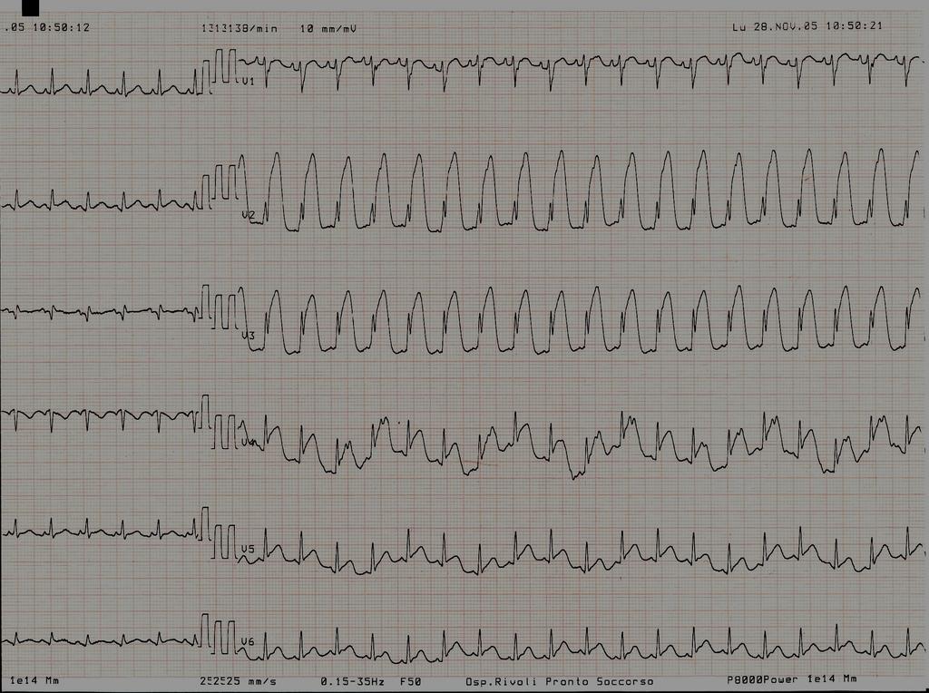 Ecg pre