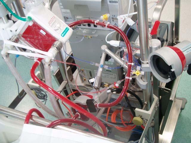 ECMO