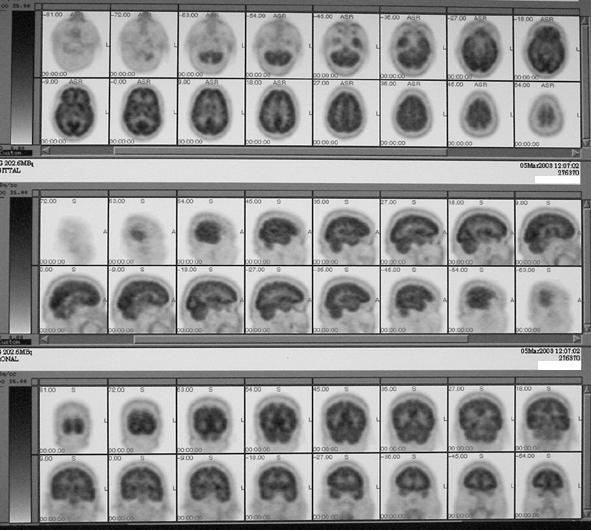 Nuclear Medicine emission tomography Sviluppo della Medicina Nucleare Milestones: Strumenti Cyclotron (1929) Nuclear reactor (1945) Rectilinear scanner (1951) Anger camera (1958) Computer (1969) PET