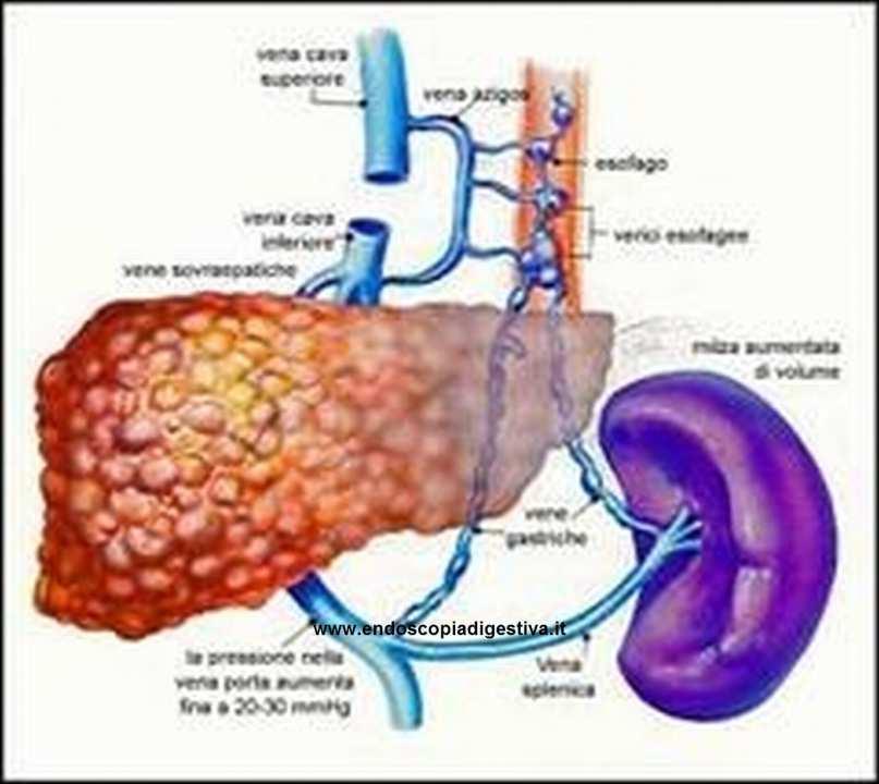 VARICI ESOFAGEE -Circa 50% pz con cirrosi hanno varici (prevale Child B-C). - In 1 anno quota di sviluppo 7% e sanguinamento 12%.
