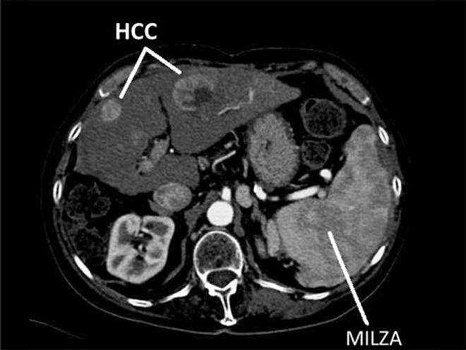 tumore Principale causa HBV-HCV.