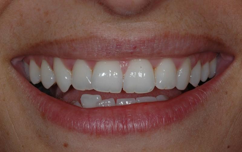 Sorriso simpatico, grazie: 1) alla bella tinta di colore (A2/A1), colore chiarissimo, 2) al colore dei colletti non più giallo come in genere si verifica, 3) alle giovani trasparenze incisali.