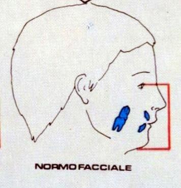 1. Il rapporto tra le lunghezze dei margini gengivali (le parabole) dei denti corrispondenti di destra e di sinistra deve essere simmetrico. 2.