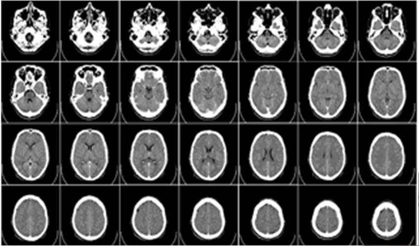 org/wikipedia/commons/thumb/5/50/computed_tomography_of_human_brain_- _large.