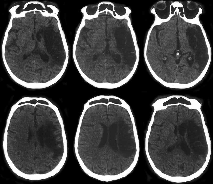 Tecniche di neuroimmagine Tomografia computerizzata (TC) Tomografia computerizzata. Lesione ipodensa (nera) emisferica destra [fonte: Rode, G.