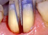 - La ricostruzione dei denti da protesizzare: come, quando e