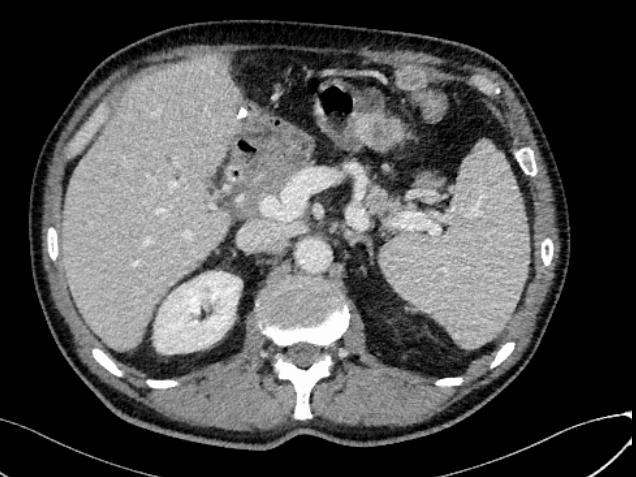 TC: Lievemente ridotta la formazione di circa 2,5 cm, adesa a ridosso della parete addominale anteriore dell'ipocondrio sn.