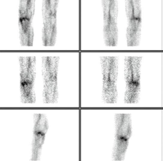 APPLICAZIONI CLINICHE ARTRITE INFETTIVA Infiammazione dell articolazione conseguente a infezione batterica, fungina, o virale dei tessuti sinoviali o periarticolari.