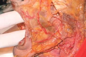 Dissezione su cadavere dopo la rimozione di cute e sottocute che evidenzia il decorso dell arteria faciale e dei suoi rami terminali