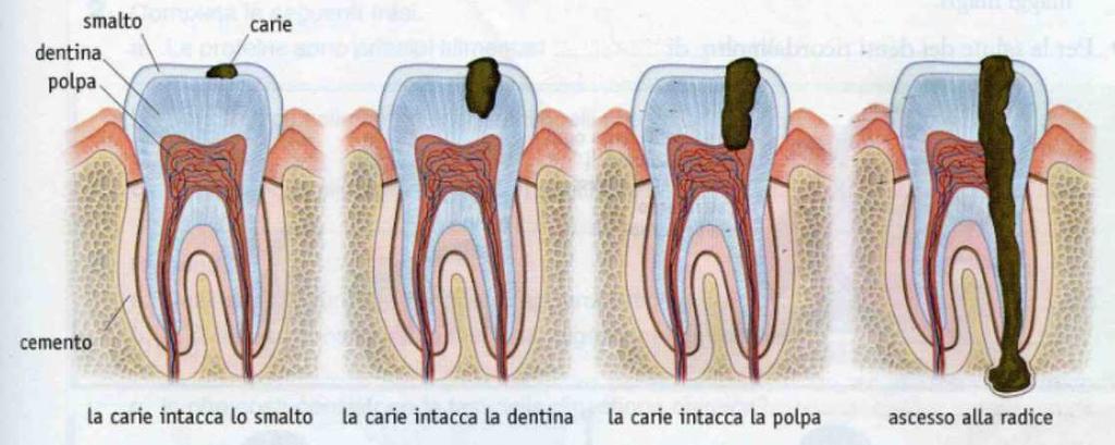 Quando la carie raggiunge la polpa dentaria, questa si infiamma (ascesso alla radice), generando il "mal di denti".