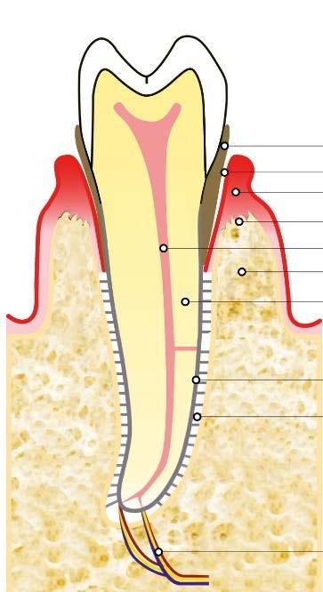 parodonto profondo (rettangolo grande). e A sinistra: Dente sano, la gengiva e l osso sono sani, vedi PDF2.