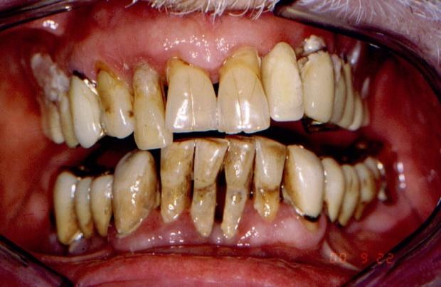A sinistra: Parodontite avanzata (PBD, tartaro, recessioni gengivali, tasche parodontali con